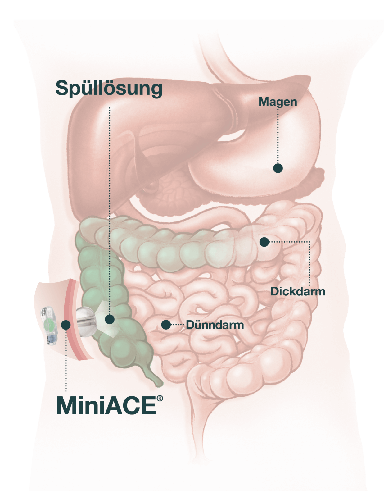 Was ist eine antegrade Darmspülung?