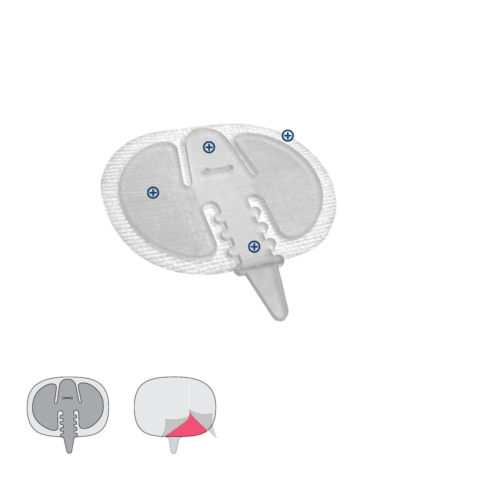 Was ist eine CINCH® Kanülenfixierung?
