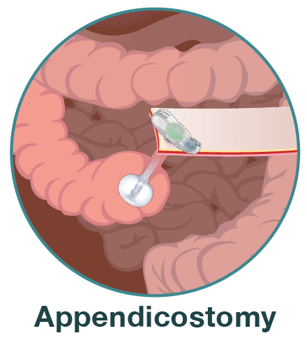 Appendikostomie